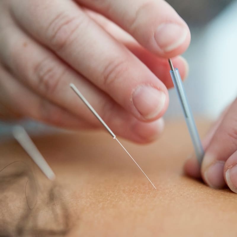 Acupuntura